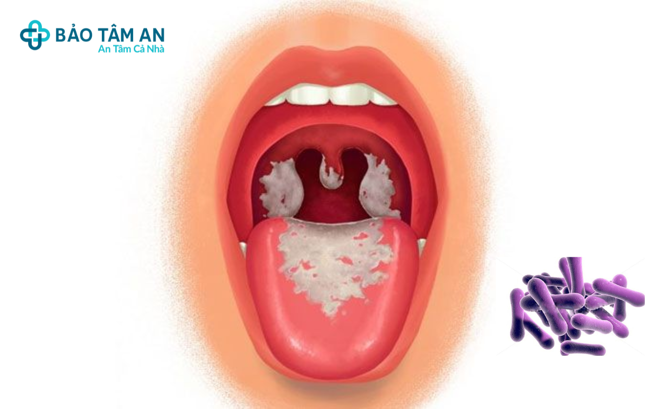 cach-phong-ngua-benh-bach-hau-bao-tam-an